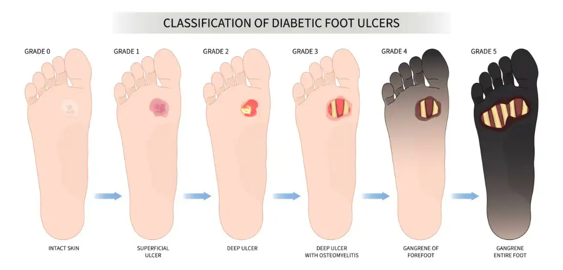 clasificación de las úlceras del pie diabético